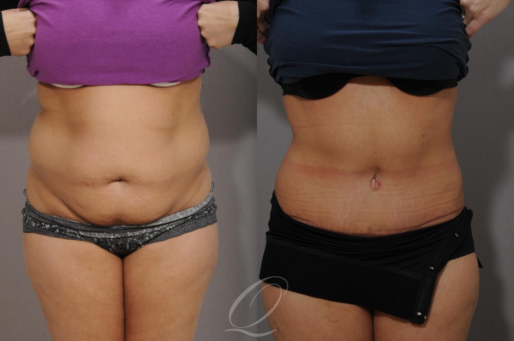 Tummy Tuck Case 1063 Before & After View #1 | Serving Rochester, Syracuse & Buffalo, NY | Quatela Center for Plastic Surgery