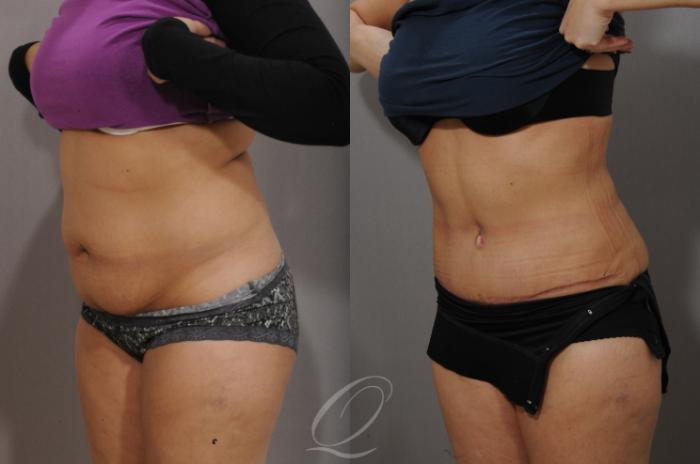 Tummy Tuck Case 1063 Before & After View #2 | Serving Rochester, Syracuse & Buffalo, NY | Quatela Center for Plastic Surgery