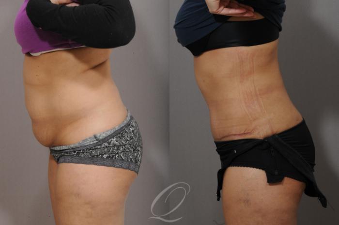 Tummy Tuck Case 1063 Before & After View #3 | Serving Rochester, Syracuse & Buffalo, NY | Quatela Center for Plastic Surgery