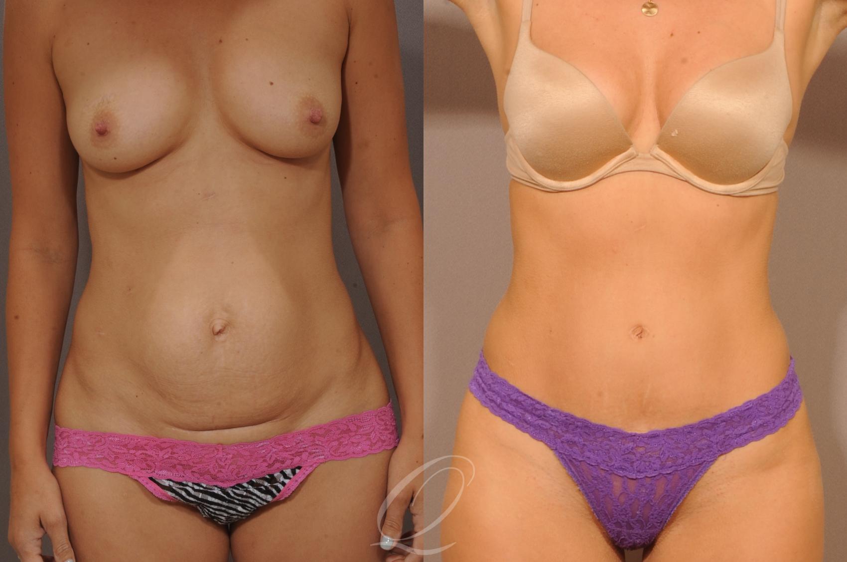 Tummy Tuck Case 1064 Before & After View #1 | Serving Rochester, Syracuse & Buffalo, NY | Quatela Center for Plastic Surgery