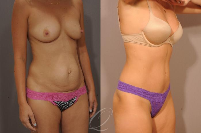 Tummy Tuck Case 1064 Before & After View #2 | Serving Rochester, Syracuse & Buffalo, NY | Quatela Center for Plastic Surgery