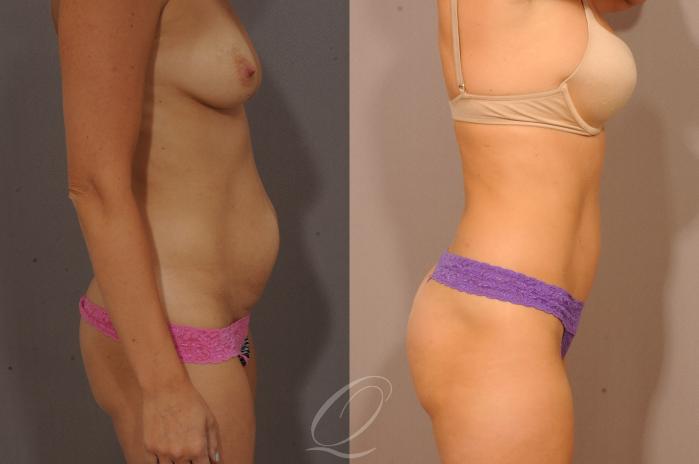 Tummy Tuck Case 1064 Before & After View #3 | Serving Rochester, Syracuse & Buffalo, NY | Quatela Center for Plastic Surgery