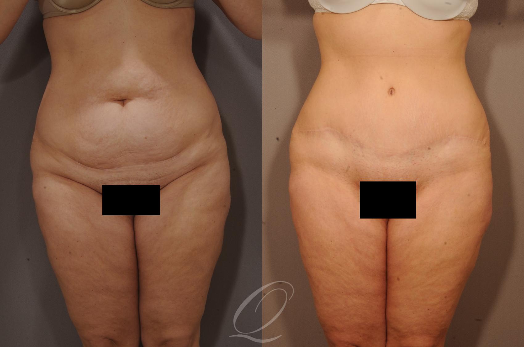 Tummy Tuck Case 1115 Before & After View #1 | Serving Rochester, Syracuse & Buffalo, NY | Quatela Center for Plastic Surgery
