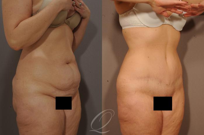 Tummy Tuck Case 1115 Before & After View #2 | Serving Rochester, Syracuse & Buffalo, NY | Quatela Center for Plastic Surgery