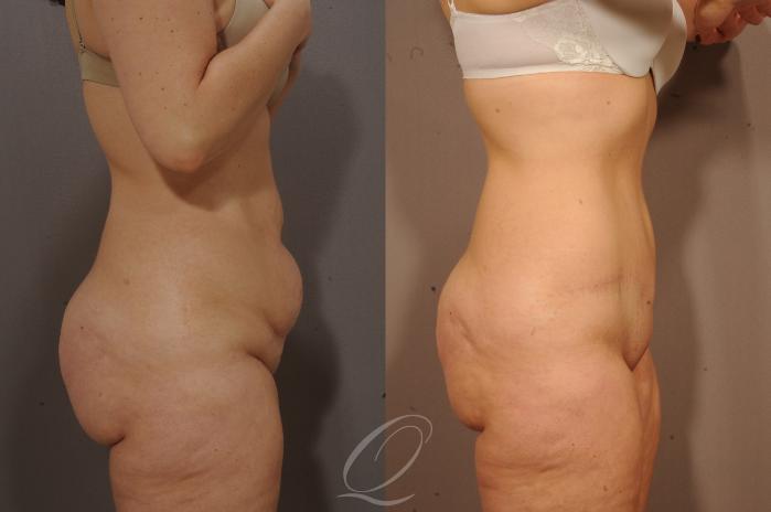 Tummy Tuck Case 1115 Before & After View #3 | Serving Rochester, Syracuse & Buffalo, NY | Quatela Center for Plastic Surgery