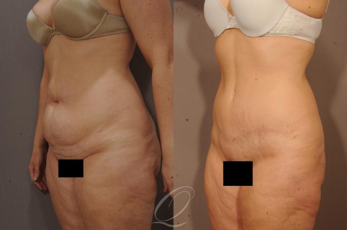 Tummy Tuck Case 1115 Before & After View #4 | Serving Rochester, Syracuse & Buffalo, NY | Quatela Center for Plastic Surgery