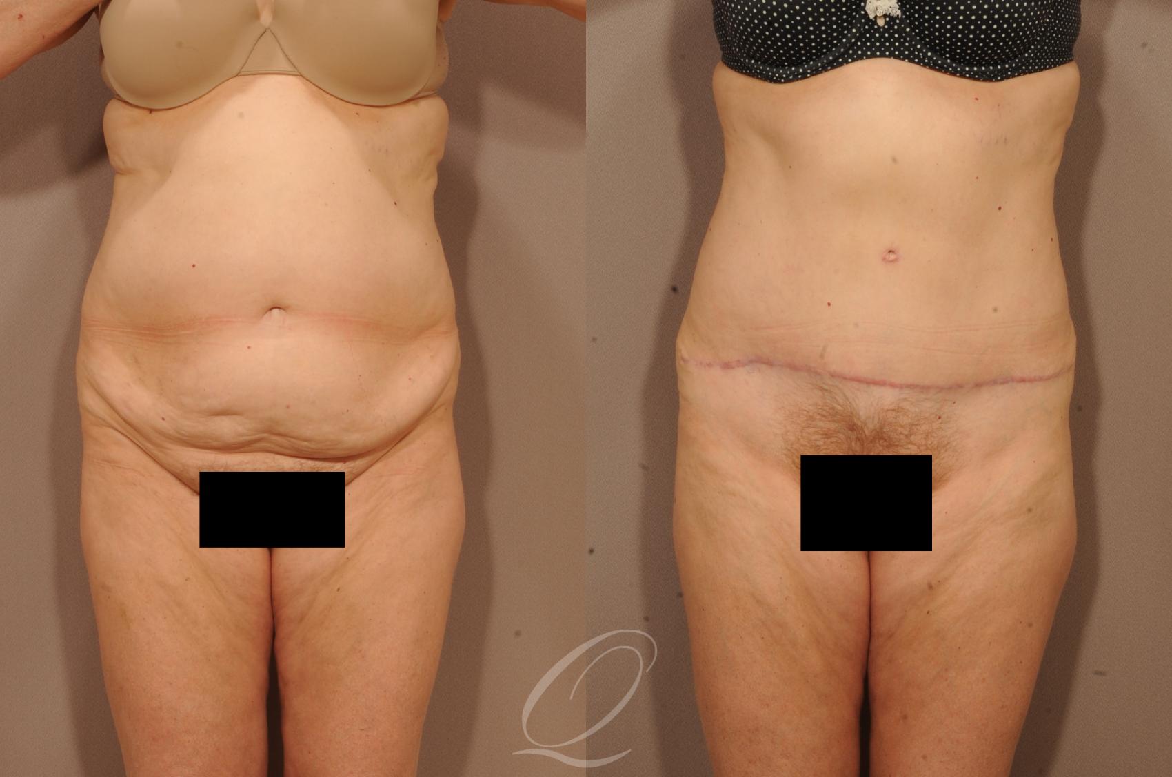 Tummy Tuck Case 1117 Before & After View #1 | Serving Rochester, Syracuse & Buffalo, NY | Quatela Center for Plastic Surgery
