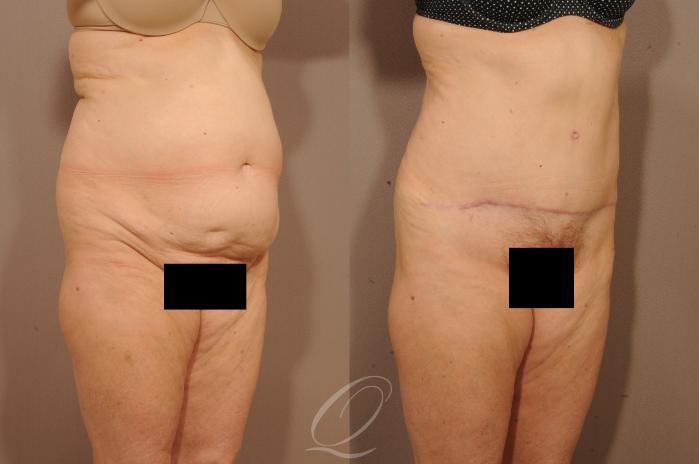 Tummy Tuck Case 1117 Before & After View #2 | Serving Rochester, Syracuse & Buffalo, NY | Quatela Center for Plastic Surgery