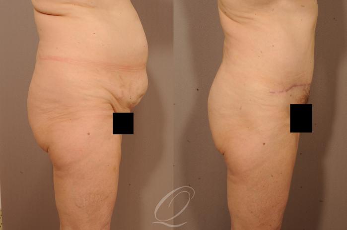Tummy Tuck Case 1117 Before & After View #3 | Serving Rochester, Syracuse & Buffalo, NY | Quatela Center for Plastic Surgery