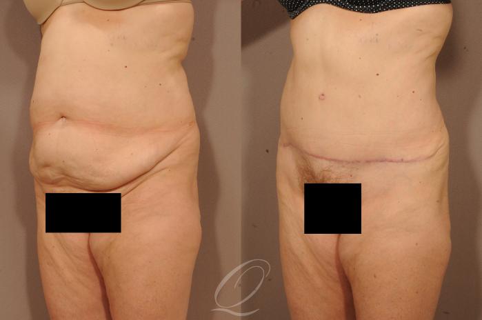 Tummy Tuck Case 1117 Before & After View #4 | Serving Rochester, Syracuse & Buffalo, NY | Quatela Center for Plastic Surgery