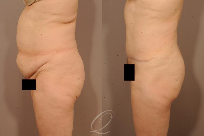 Tummy Tuck Case 1117 Before & After View #5 | Serving Rochester, Syracuse & Buffalo, NY | Quatela Center for Plastic Surgery