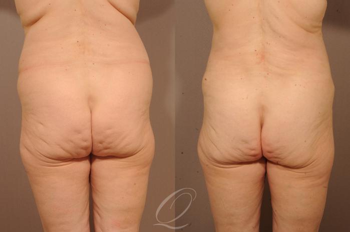 Tummy Tuck Case 1117 Before & After View #6 | Serving Rochester, Syracuse & Buffalo, NY | Quatela Center for Plastic Surgery