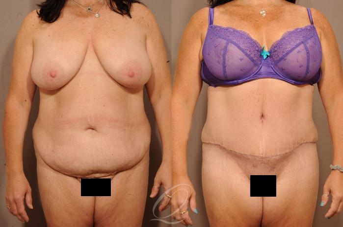 Tummy Tuck Case 1134 Before & After View #1 | Serving Rochester, Syracuse & Buffalo, NY | Quatela Center for Plastic Surgery