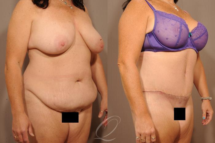 Tummy Tuck Case 1134 Before & After View #2 | Serving Rochester, Syracuse & Buffalo, NY | Quatela Center for Plastic Surgery