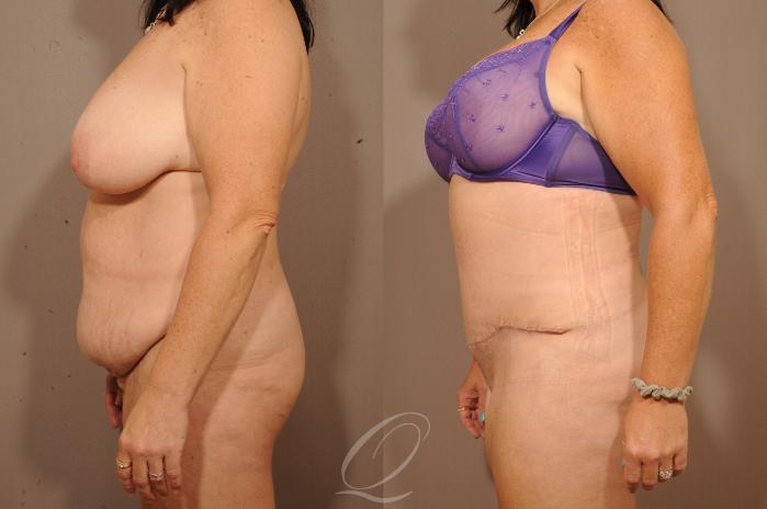 Tummy Tuck Case 1134 Before & After View #3 | Serving Rochester, Syracuse & Buffalo, NY | Quatela Center for Plastic Surgery