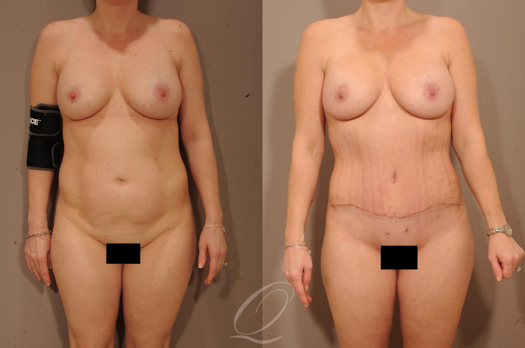 Tummy Tuck Case 1145 Before & After View #1 | Serving Rochester, Syracuse & Buffalo, NY | Quatela Center for Plastic Surgery