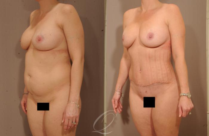 Tummy Tuck Case 1145 Before & After View #2 | Serving Rochester, Syracuse & Buffalo, NY | Quatela Center for Plastic Surgery