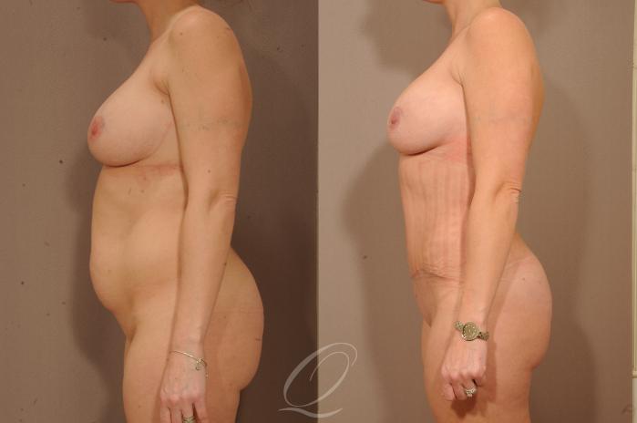 Tummy Tuck Case 1145 Before & After View #3 | Serving Rochester, Syracuse & Buffalo, NY | Quatela Center for Plastic Surgery