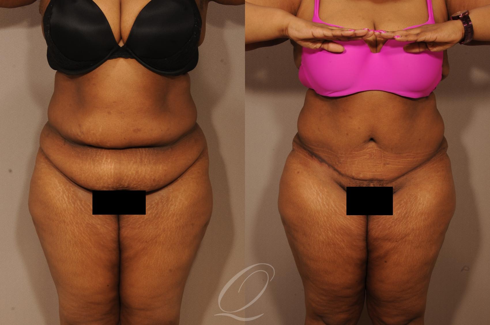 Tummy Tuck Case 1159 Before & After View #1 | Serving Rochester, Syracuse & Buffalo, NY | Quatela Center for Plastic Surgery