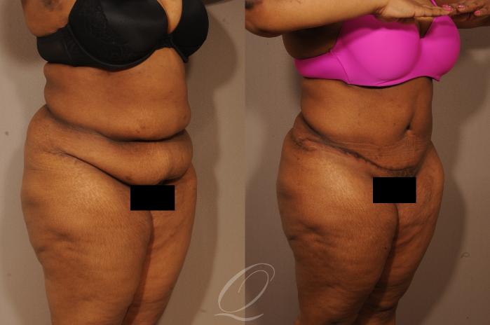 Tummy Tuck Case 1159 Before & After View #2 | Serving Rochester, Syracuse & Buffalo, NY | Quatela Center for Plastic Surgery