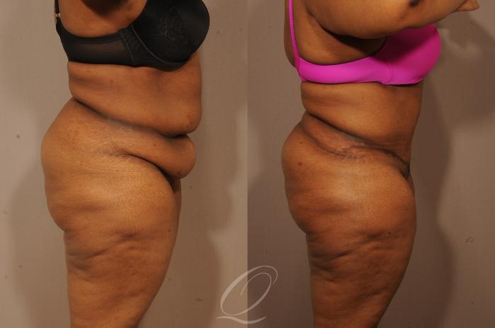 Tummy Tuck Case 1159 Before & After View #3 | Serving Rochester, Syracuse & Buffalo, NY | Quatela Center for Plastic Surgery