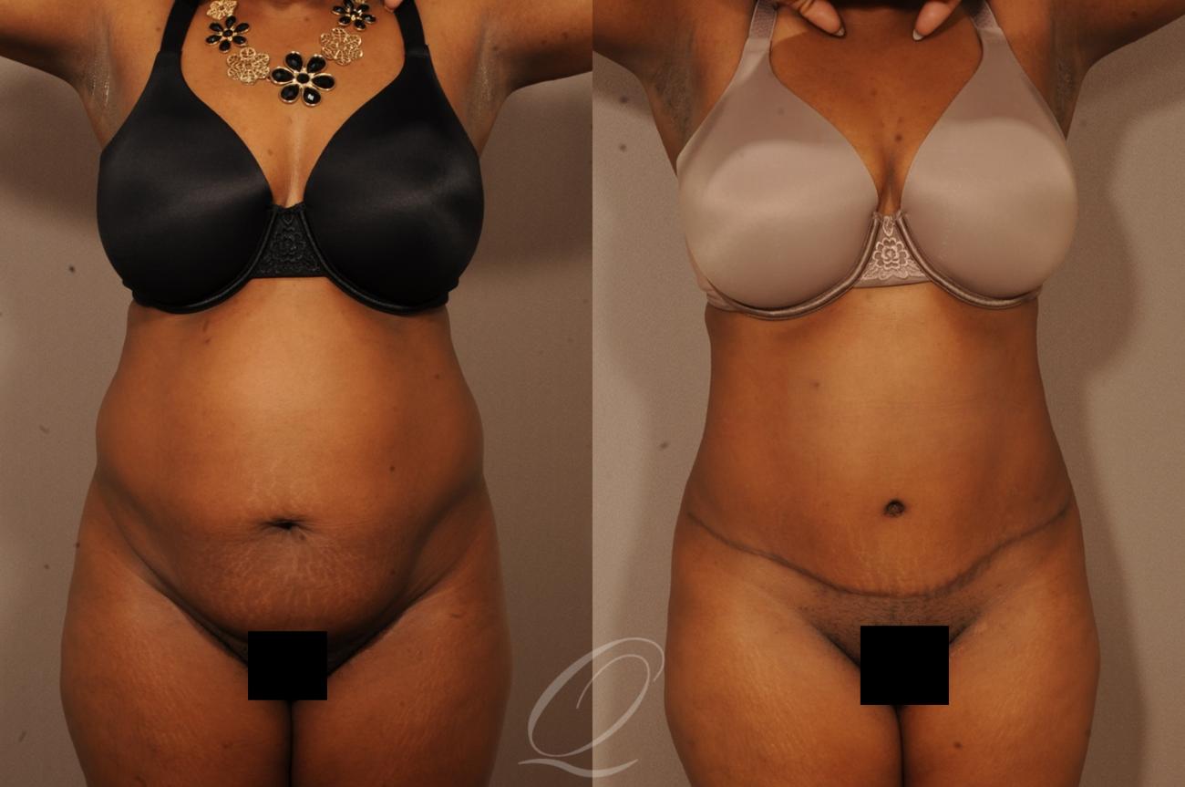 Tummy Tuck Case 286 Before & After View #1 | Serving Rochester, Syracuse & Buffalo, NY | Quatela Center for Plastic Surgery