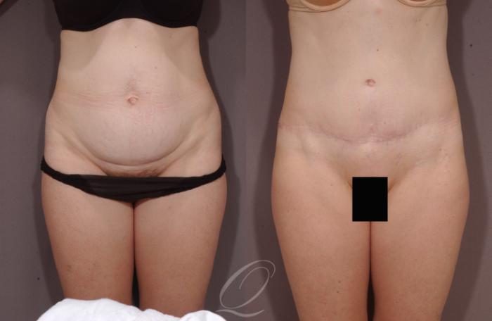 Tummy Tuck Case 131 Before & After View #1 | Serving Rochester, Syracuse & Buffalo, NY | Quatela Center for Plastic Surgery