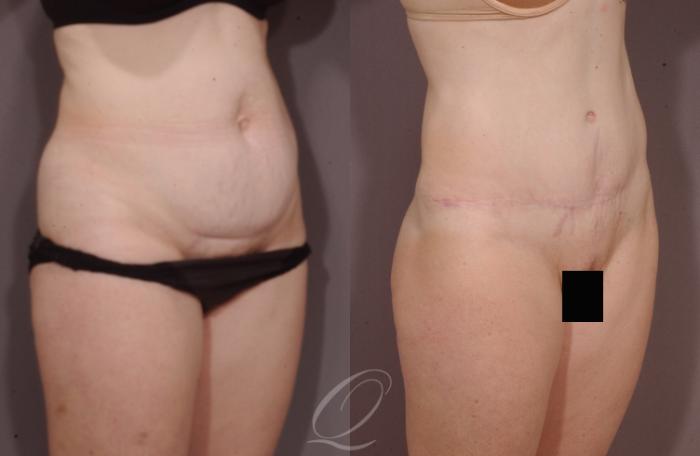 Tummy Tuck Case 131 Before & After View #2 | Serving Rochester, Syracuse & Buffalo, NY | Quatela Center for Plastic Surgery
