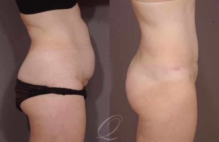 Tummy Tuck Case 131 Before & After View #3 | Serving Rochester, Syracuse & Buffalo, NY | Quatela Center for Plastic Surgery