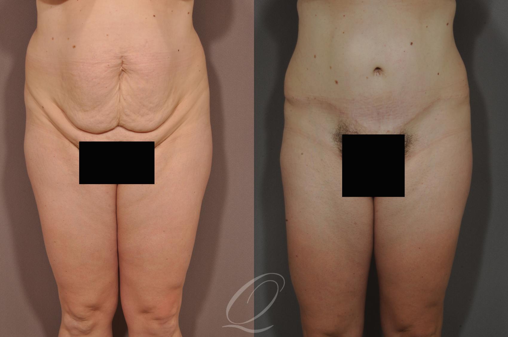 Tummy Tuck Case 132 Before & After View #1 | Serving Rochester, Syracuse & Buffalo, NY | Quatela Center for Plastic Surgery