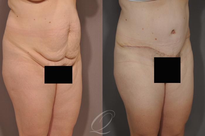 Tummy Tuck Case 132 Before & After View #2 | Serving Rochester, Syracuse & Buffalo, NY | Quatela Center for Plastic Surgery