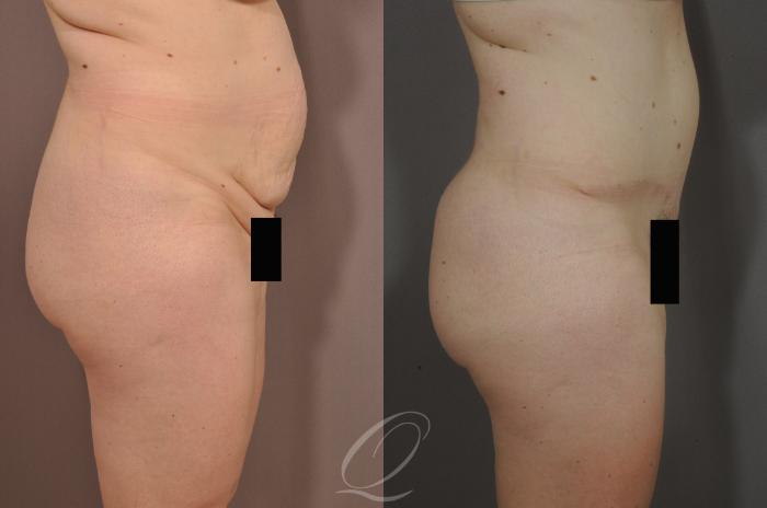 Tummy Tuck Case 132 Before & After View #3 | Serving Rochester, Syracuse & Buffalo, NY | Quatela Center for Plastic Surgery
