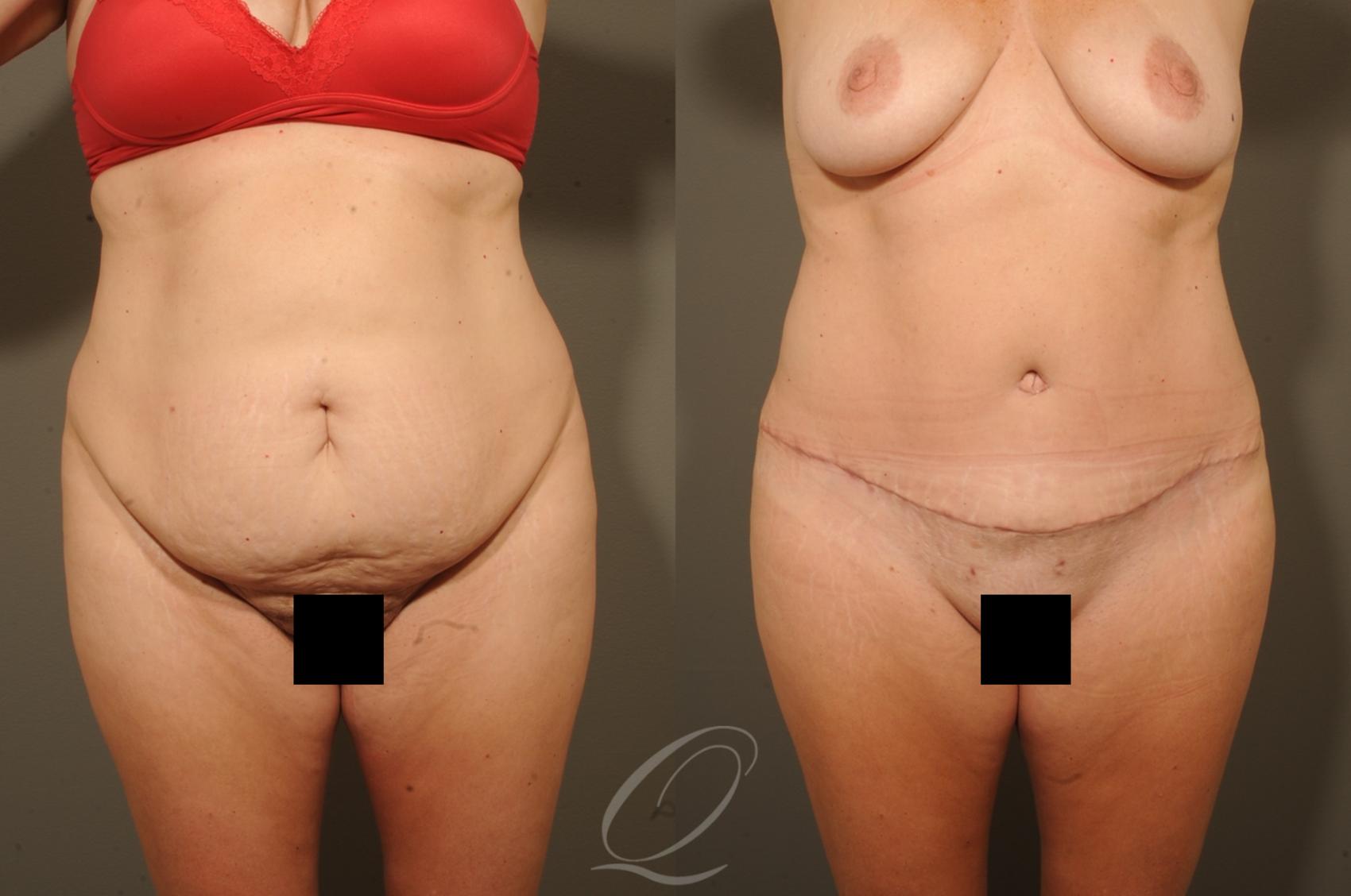 Tummy Tuck Case 1328 Before & After View #1 | Serving Rochester, Syracuse & Buffalo, NY | Quatela Center for Plastic Surgery