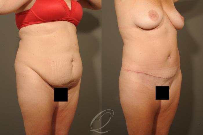 Tummy Tuck Case 1328 Before & After View #2 | Serving Rochester, Syracuse & Buffalo, NY | Quatela Center for Plastic Surgery