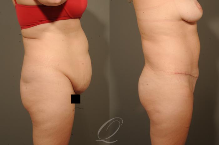 Tummy Tuck Case 1328 Before & After View #3 | Serving Rochester, Syracuse & Buffalo, NY | Quatela Center for Plastic Surgery