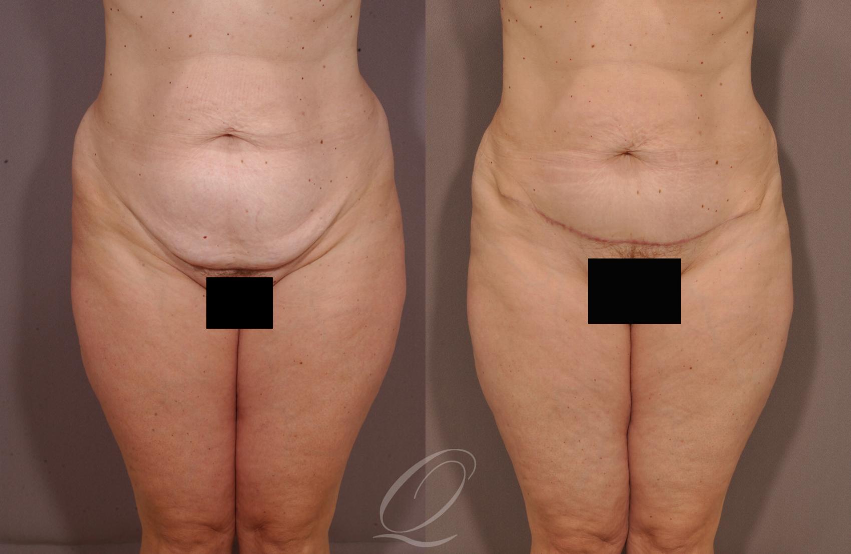 Tummy Tuck Case 133 Before & After View #1 | Serving Rochester, Syracuse & Buffalo, NY | Quatela Center for Plastic Surgery