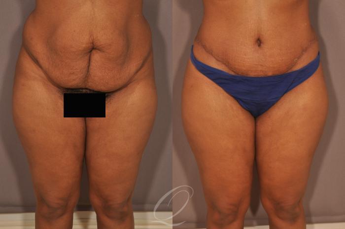 Tummy Tuck Case 134 Before & After View #1 | Serving Rochester, Syracuse & Buffalo, NY | Quatela Center for Plastic Surgery