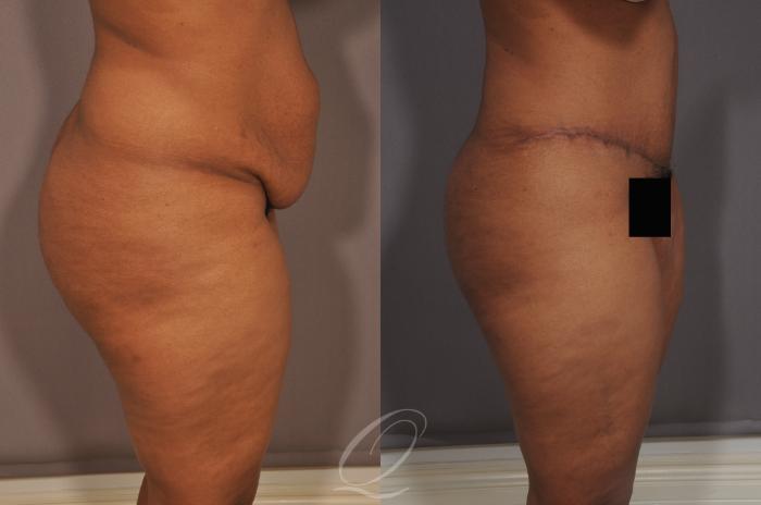 Tummy Tuck Case 134 Before & After View #2 | Serving Rochester, Syracuse & Buffalo, NY | Quatela Center for Plastic Surgery
