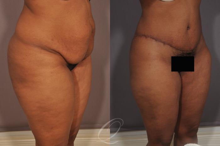 Tummy Tuck Case 134 Before & After View #3 | Serving Rochester, Syracuse & Buffalo, NY | Quatela Center for Plastic Surgery