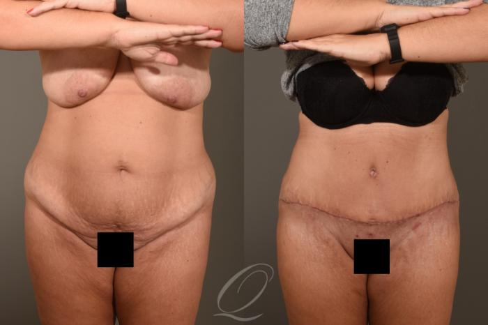 Tummy Tuck Case 1379 Before & After Front | Serving Rochester, Syracuse & Buffalo, NY | Quatela Center for Plastic Surgery