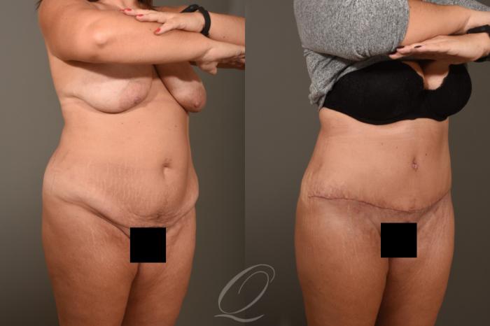 Tummy Tuck Case 1379 Before & After Right Oblique | Serving Rochester, Syracuse & Buffalo, NY | Quatela Center for Plastic Surgery