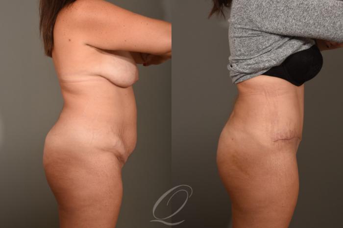Tummy Tuck Case 1379 Before & After Right Side | Serving Rochester, Syracuse & Buffalo, NY | Quatela Center for Plastic Surgery