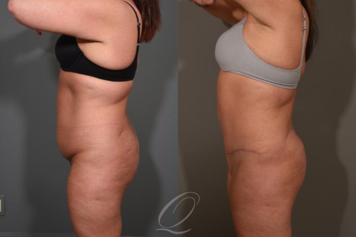 Tummy Tuck Case 1380 Before & After Left Side | Serving Rochester, Syracuse & Buffalo, NY | Quatela Center for Plastic Surgery