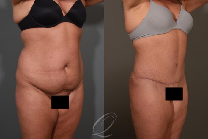 Tummy Tuck Case 1380 Before & After Right Oblique | Serving Rochester, Syracuse & Buffalo, NY | Quatela Center for Plastic Surgery