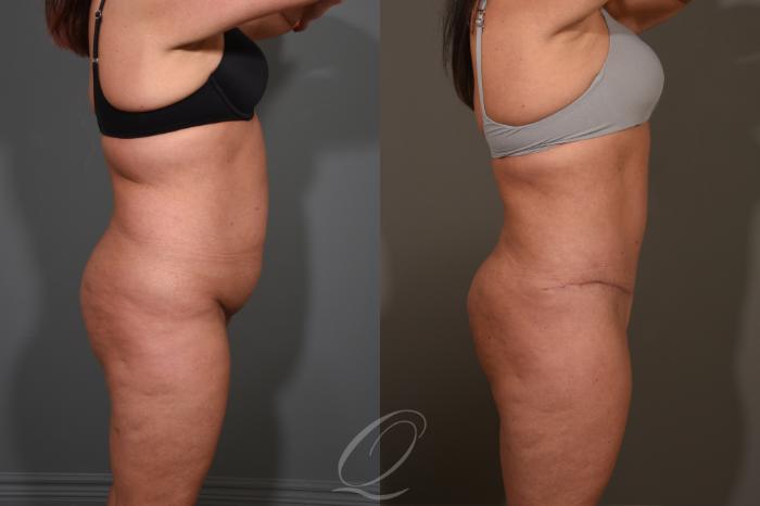 Tummy Tuck Case 1380 Before & After Right Side | Serving Rochester, Syracuse & Buffalo, NY | Quatela Center for Plastic Surgery