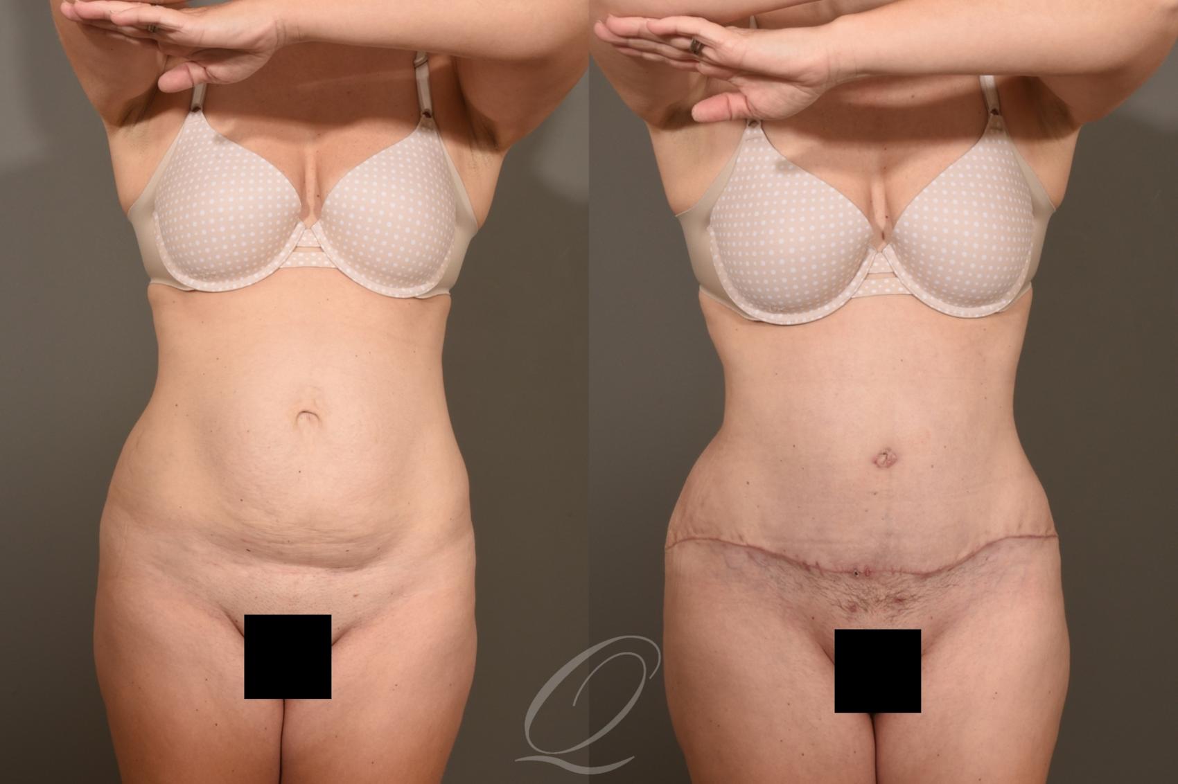 Tummy Tuck Case 1381 Before & After Front | Serving Rochester, Syracuse & Buffalo, NY | Quatela Center for Plastic Surgery