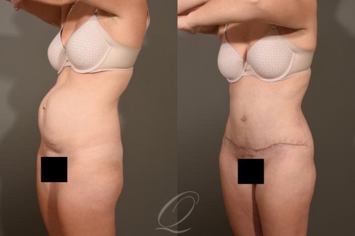 Tummy Tuck Case 1381 Before & After Left Oblique | Serving Rochester, Syracuse & Buffalo, NY | Quatela Center for Plastic Surgery