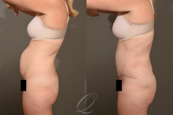 Tummy Tuck Case 1381 Before & After Left Side | Serving Rochester, Syracuse & Buffalo, NY | Quatela Center for Plastic Surgery