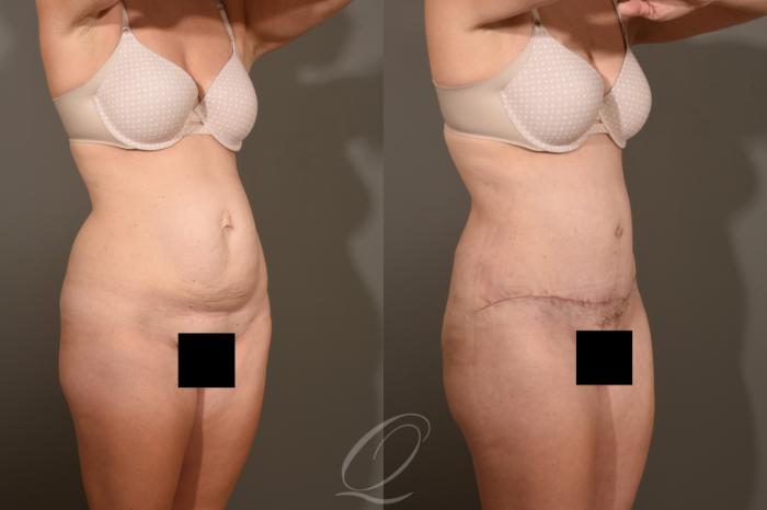 Tummy Tuck Case 1381 Before & After Right Oblique | Serving Rochester, Syracuse & Buffalo, NY | Quatela Center for Plastic Surgery