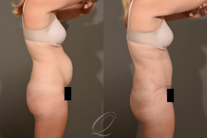 Tummy Tuck Case 1381 Before & After Right Side | Serving Rochester, Syracuse & Buffalo, NY | Quatela Center for Plastic Surgery